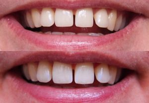 Swiss Whitening tænder før og efter