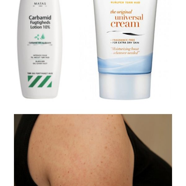 Keratosis Pilaris kollage