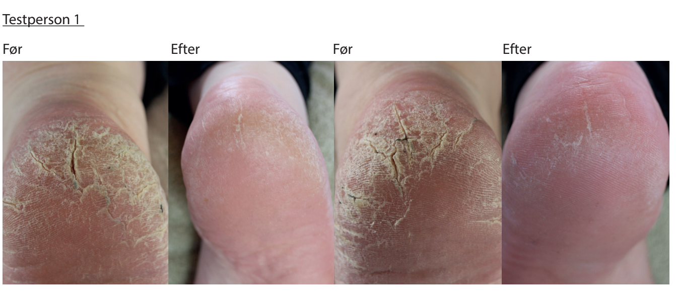 Sådan fjerner hård hud og revner på fødder og hæle - PUDDERDÅSERNE