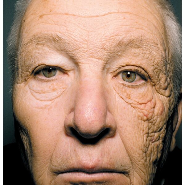 UV skade på lastbilchauffør